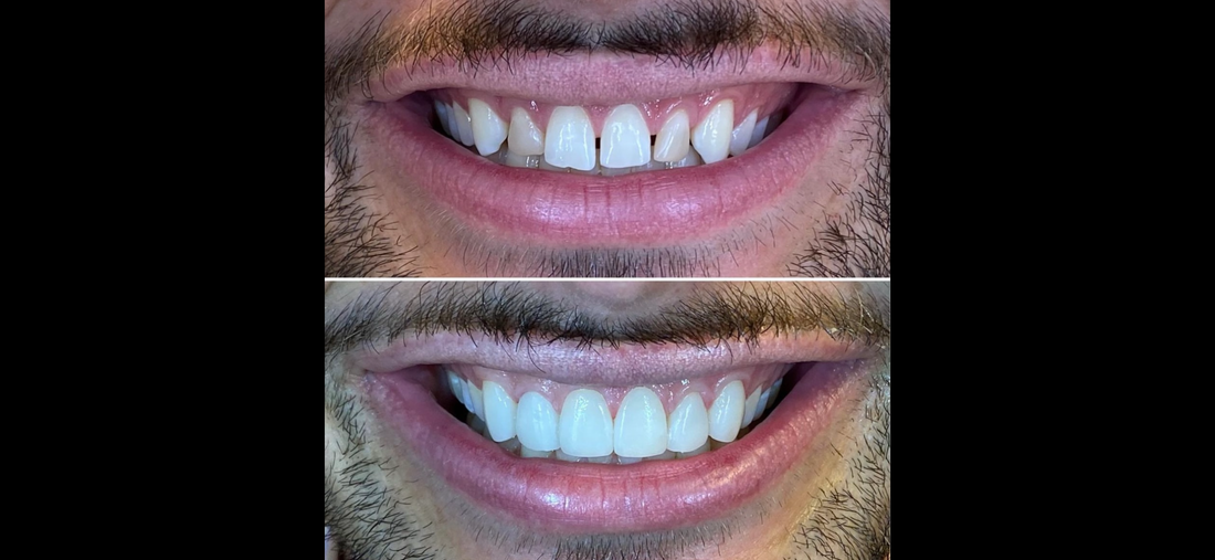 Teeth Whitening